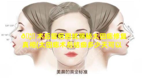 🦍 术后留疤困扰揭秘太田痣修复真相(太田痣术后结痂多少天可以掉了)